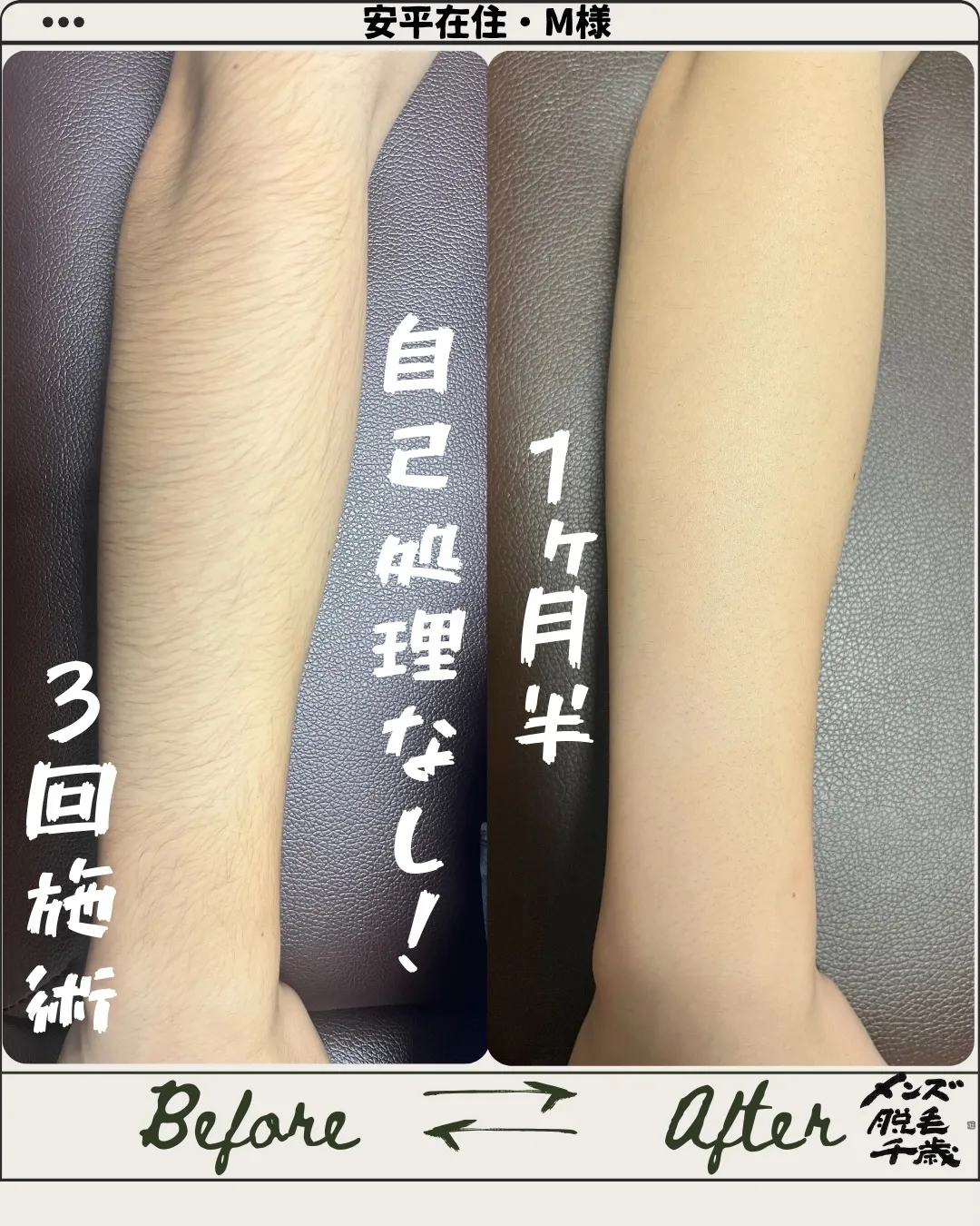 💪腕脱毛【3回施術】