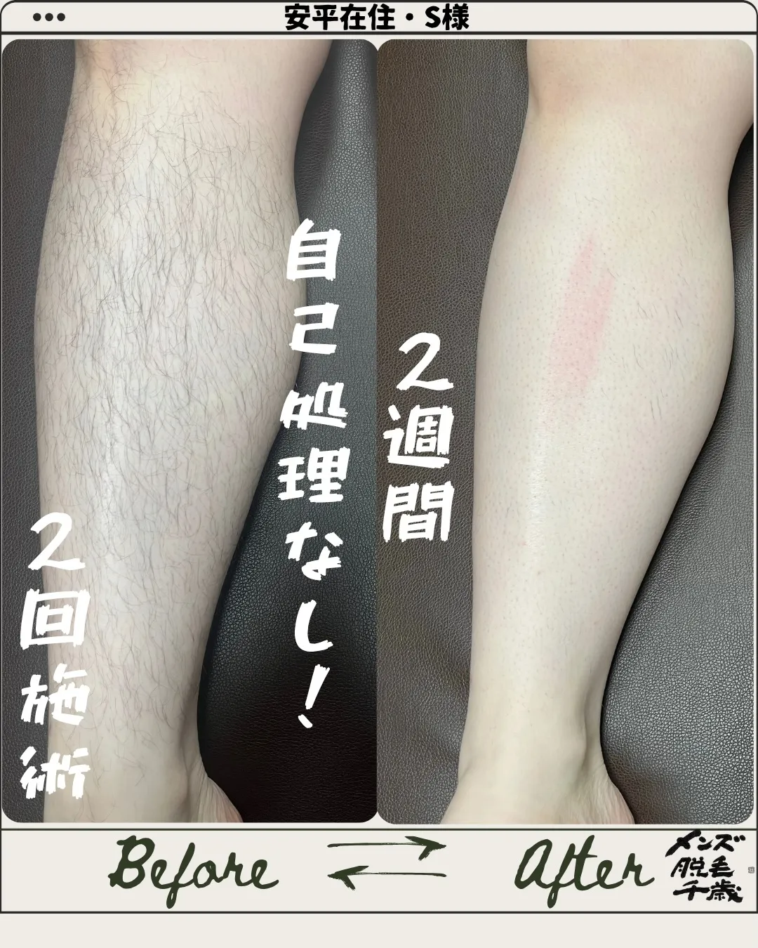 【たった2回でこの違い💥 夏、まだ間に合います!】